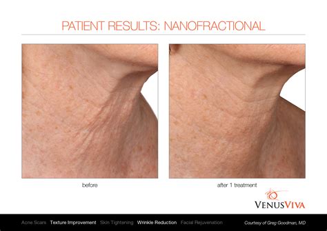 Venus Viva Neck Lines Reduction .